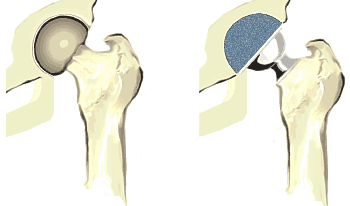 The ORI-How an Artificial Hip Compares to a Healthy, Natural Hip